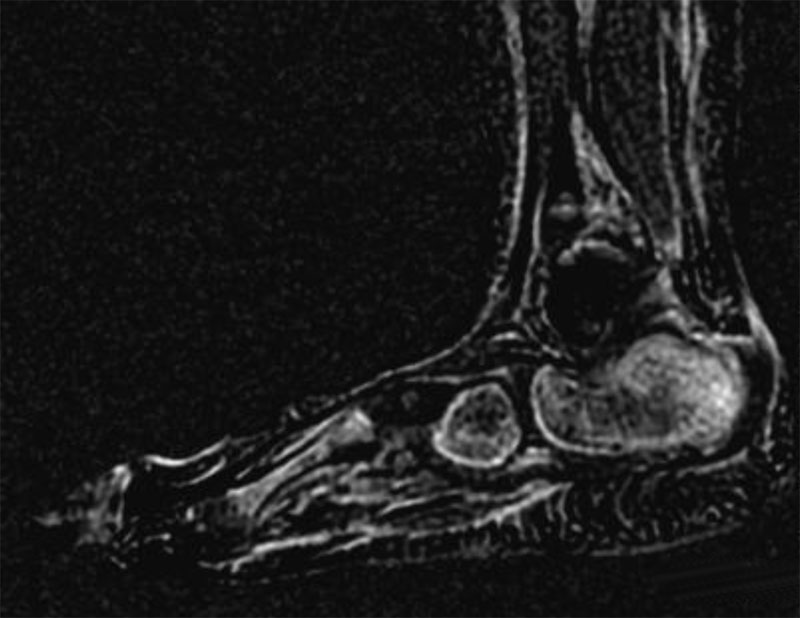 Imagerie Pathologie Arriere Pied Cas Enfant Ans